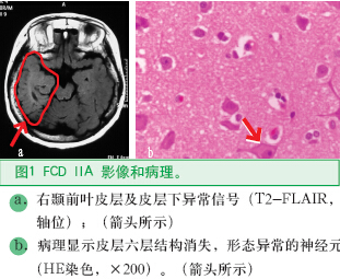 圖1 FCD IIA 影像和病理。