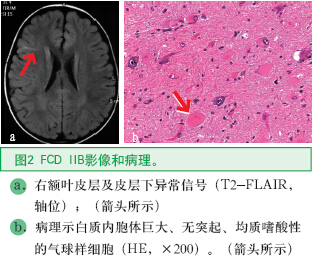 圖2 FCD IIB影像和病理。