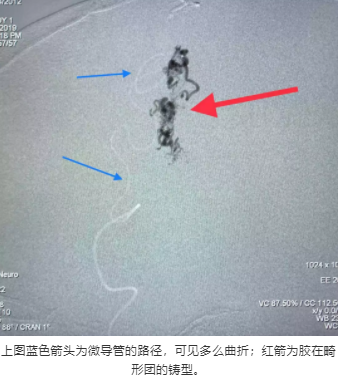上圖藍色箭頭為微導(dǎo)管的路徑，可見多么曲折；紅箭為膠在畸形團的鑄型。