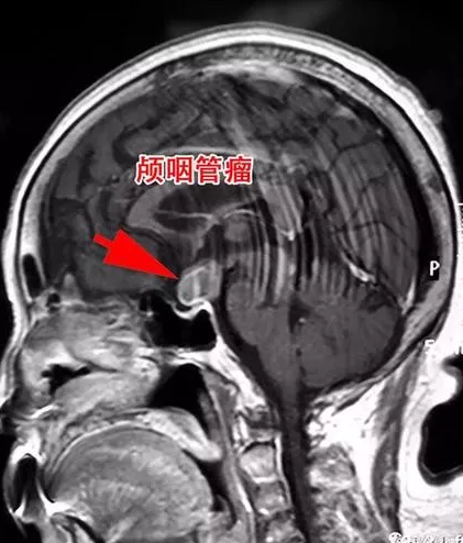 不愿失明堅(jiān)持要開顱手術(shù)
