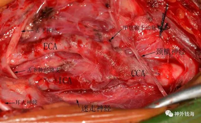 三博腦科屆頸動脈內(nèi)膜剝脫術(shù)學(xué)習(xí)班邀請函
