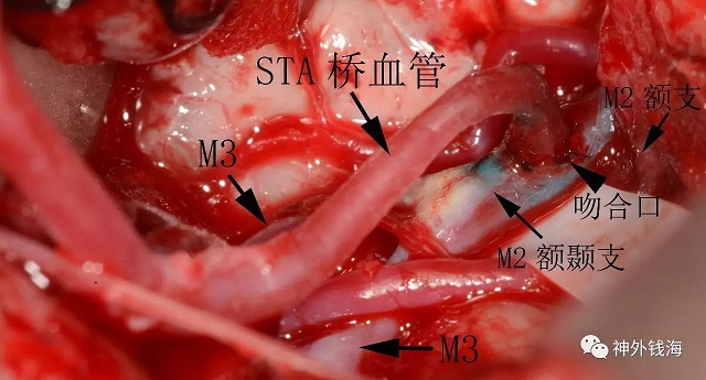 煙霧病術(shù)中照片，顯示相關(guān)結(jié)構(gòu)