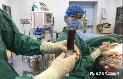 頭部外傷引起頭痛長(zhǎng)達(dá)4月之久，三博江陵醫(yī)院2天去除病根