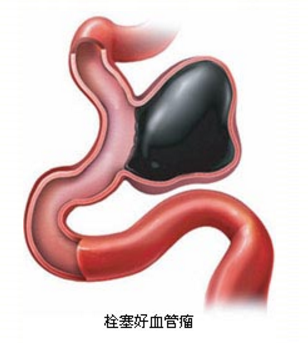 栓塞好的動(dòng)脈瘤