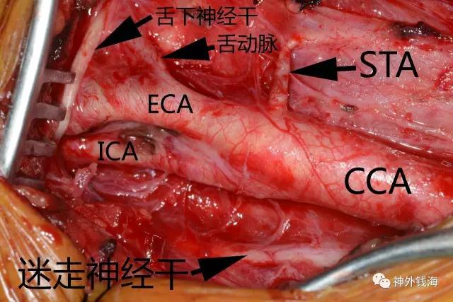 煙霧病術(shù)中照片，顯示相關(guān)結(jié)構(gòu)
