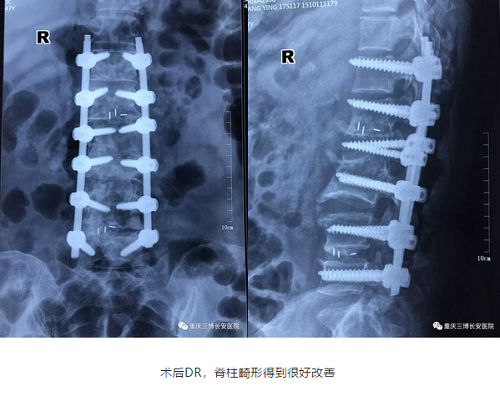 術(shù)后DR，脊柱畸形得到很好改善