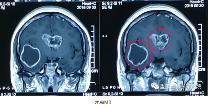 術前MRI