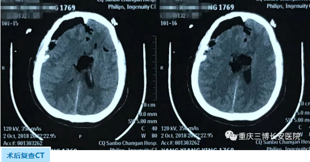術后復查CT 術后復查CT