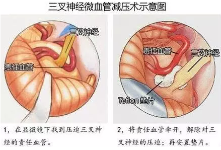 三叉神經(jīng)痛、面肌痙攣……MVD手術(shù)全搞定