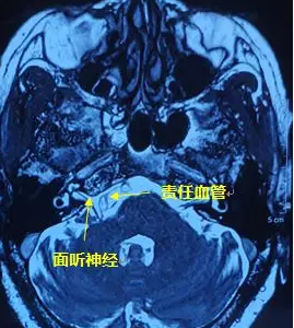 右眼跳”災(zāi)“？小心面肌痙攣！
