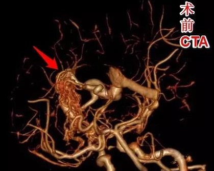 6小時30分 顱內(nèi)巧拆“彈”-術(shù)前CTA