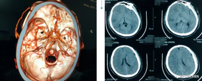 急診CT+CTA證實(shí)鄧先生發(fā)生急性腦梗死