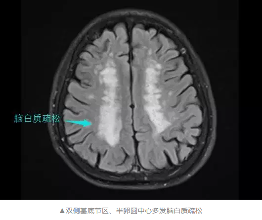雙側(cè)基底節(jié)區(qū)、半卵圓中心多發(fā)腦白質(zhì)疏松