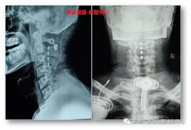 “植物人”真的無法醒過來嗎？這3種方法為昏迷促醒提供更多可能