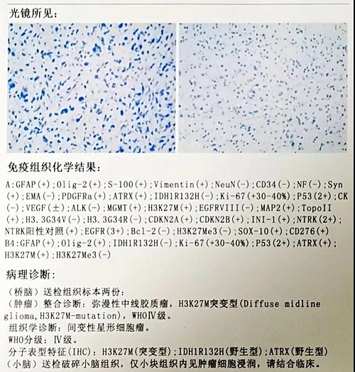 6歲女童“生命禁區(qū)--腦干”長惡性腫瘤，手術后“絕處逢生”！